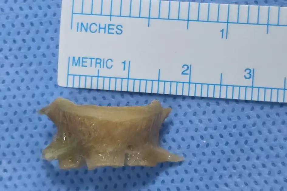 Doctors remove fish bone stuck in Sharjah man's airway for two months